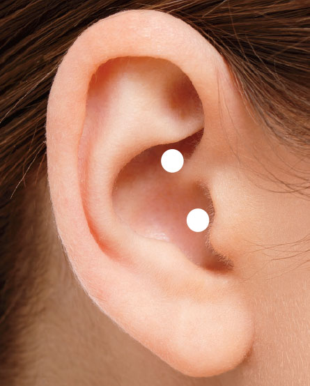 vagus ear implant